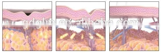 Good quality ultrasound hifu equipment manufacturer want distrobutor
