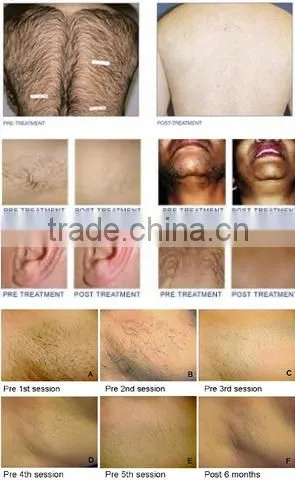 Factory Price high quality 808nm semiconductor diode laser permanet hair removal system