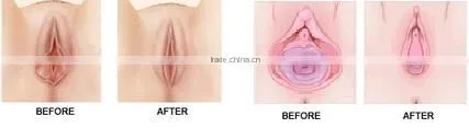 High quality hifu vaginal tightening machine