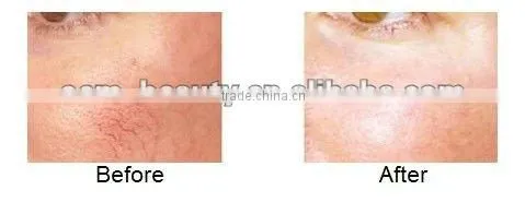 Beauty salon equipment professional long pulse laser remove hair machine-P003