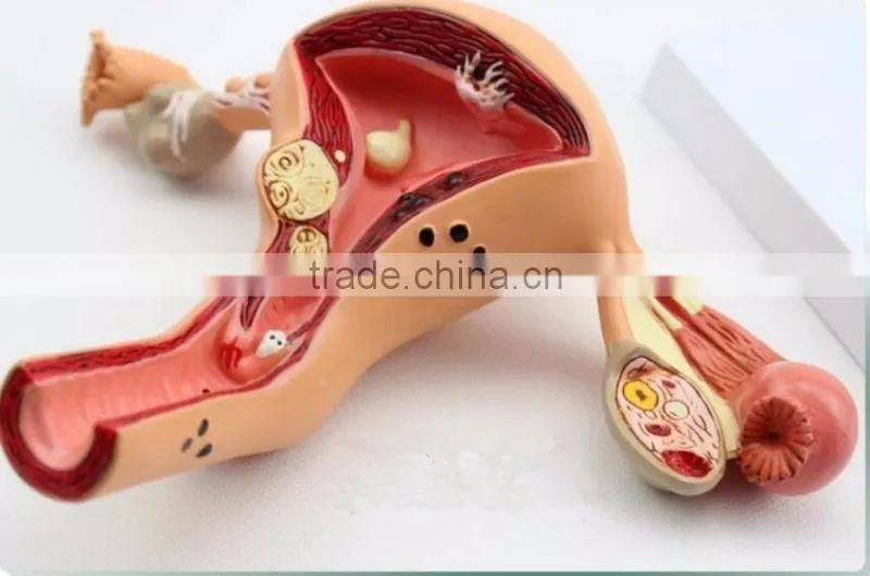 Human uterus and ovary vaginal pathological changes model of reproductive Department of gynecology medical demonstration model