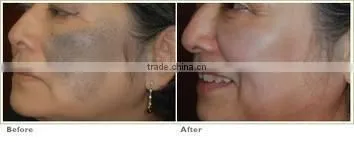 Multifunction facial beauty machine for skin rejuvenation skin care product