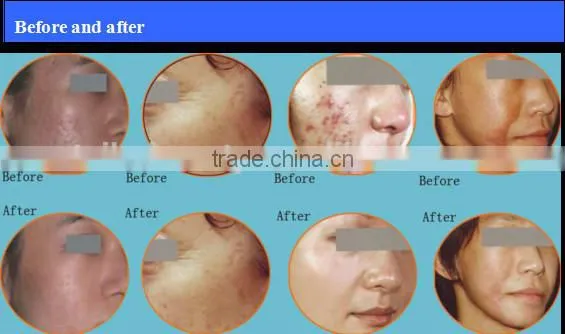 pixel co2 fractional laser