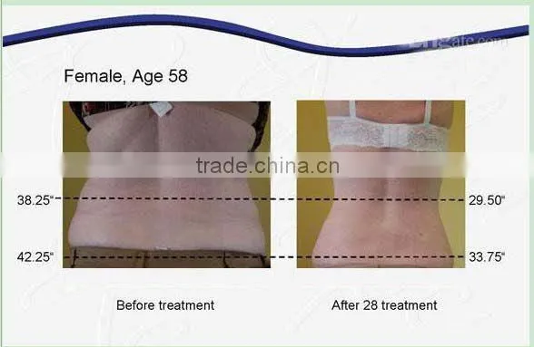 home cryolipolysis/cryolipolysis fat reducing/cryolipolysis fat slim