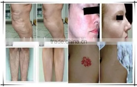 medical laser treatment equipment / laser treatment instrument / hair removal machine for women