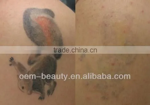Mini Q-switch ND Yag laser tattoo removal machine D003