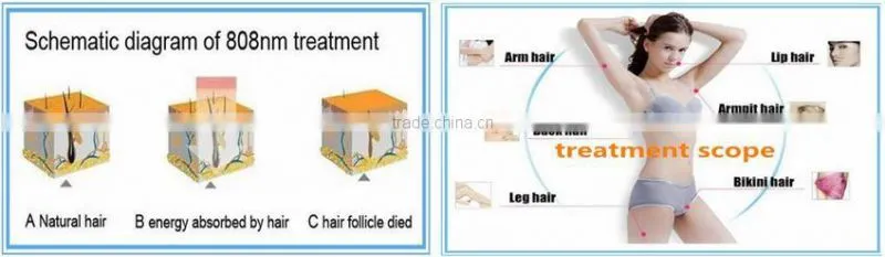 diode hair remvoal 810 / dioda laser / diode laser 808 mm rf hair removal