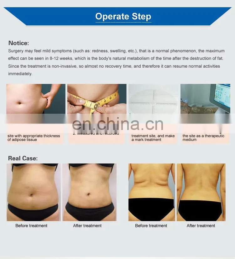 Good treatment effect belly fat burner machine/hifu body fat removal