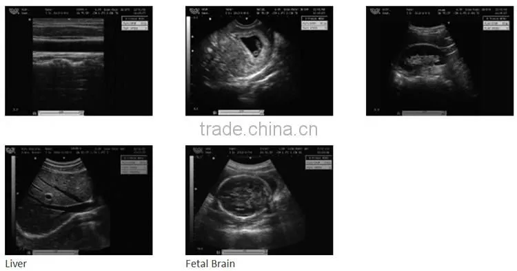 MCB-8500 High definition Black and White Ultrasound Machine best price for portable echographe doppler mindray