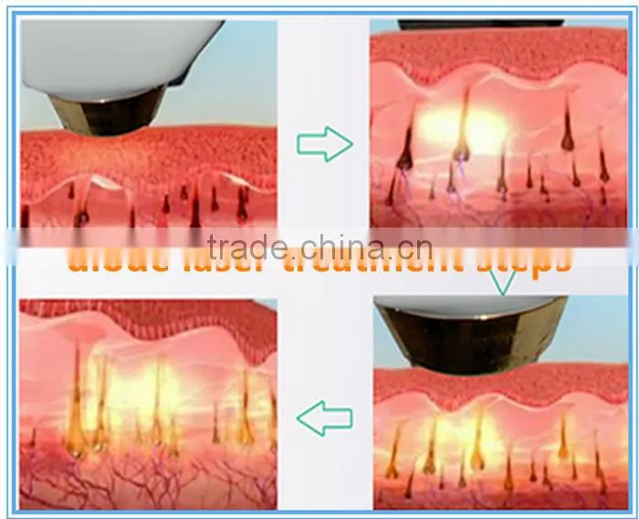 Permanent diode lazer hair removal machine