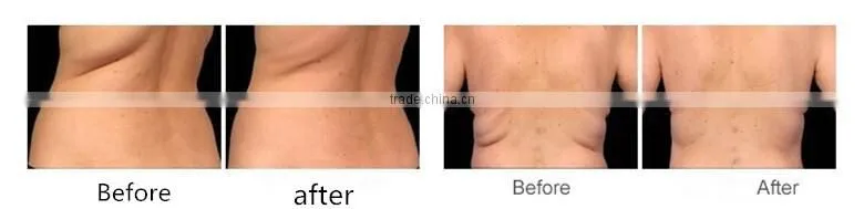 cellulite ultrasonic slimming effective slimline slimming machines