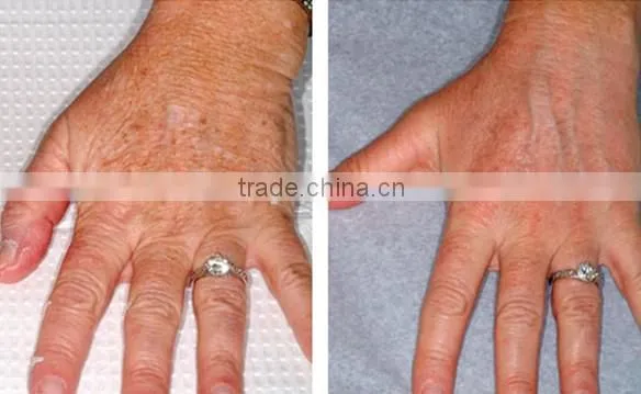 Wrinkle hair removal ipl photofacial machine with best result