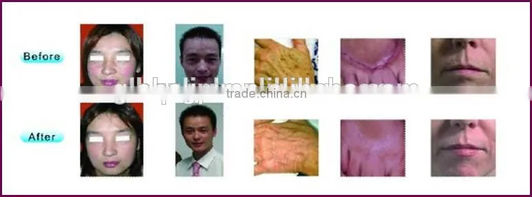 age spots removal clinic use skin renew erbuim laser skin resurfacing machine