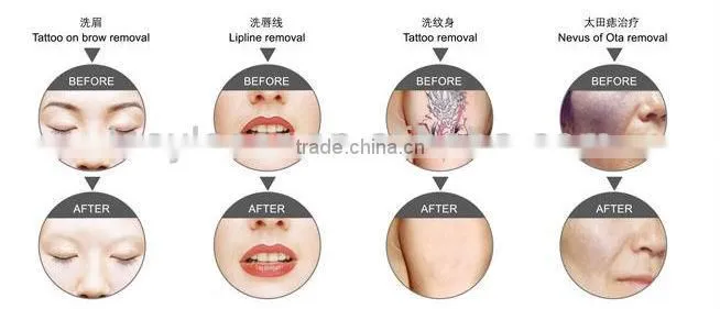 ipl e-light(e light) rf laser beauty machine (elight ipl rf nd yag laser)