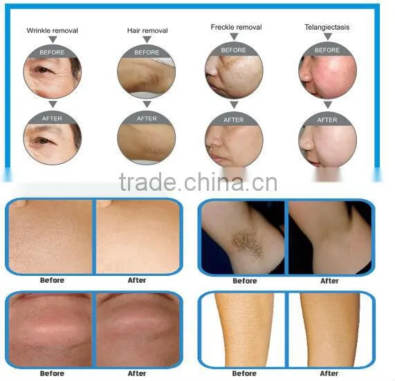 Lowest price professional ipl hair removal skin rejuvenation IPL machine
