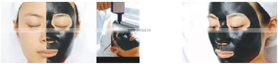 rejuvi tattoo removal q switch nd yag carbon laser