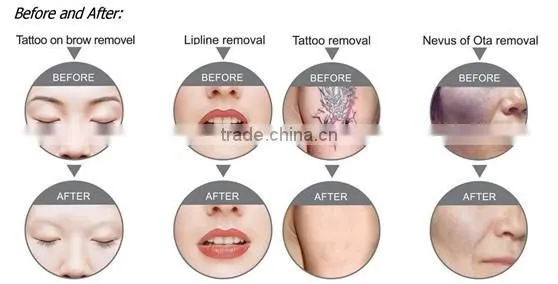 rejuvi tattoo removal q switch nd yag carbon laser