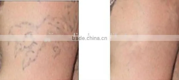 zhengjia portable RF laser face lifting and tightening beauty machine
