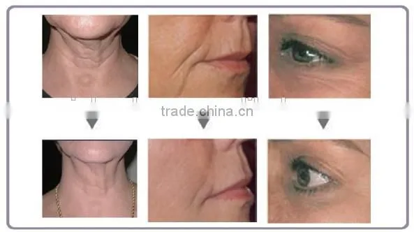 radio frequency facial machine for home use high quality rf machine