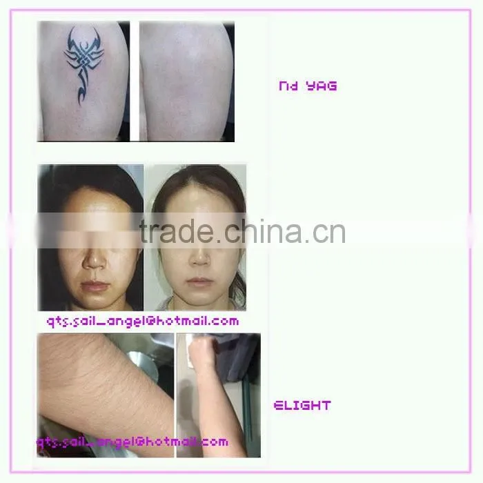 best hair removal shr opt ipl laser machine with strong power
