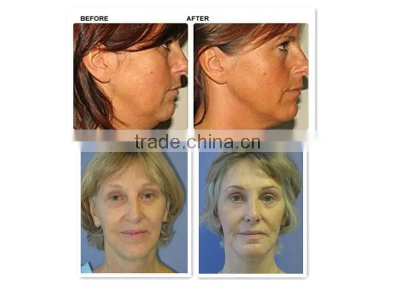 Bipolar RF wrinkle removal