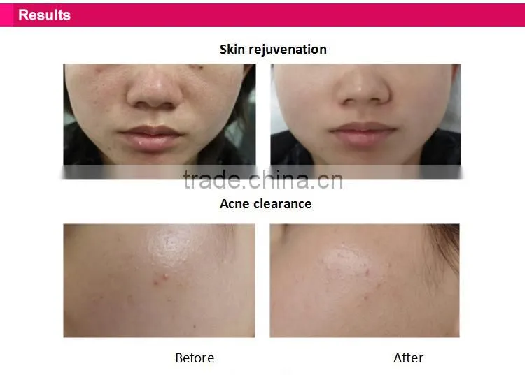 2016 lastest apollo ipl machine for body hair removal