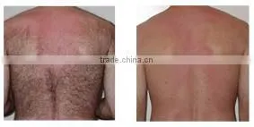 Medical equipments laser diode hair removal machine hair loss treatment diode laser 808