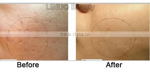2014 derma roller factory direct wholesale with good derma roller price micro needle (Professional ,Effective !!!!!!!!!!!!)
