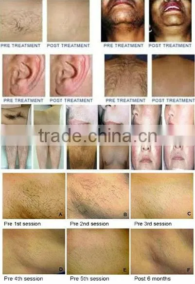 High quality pulsed light hair removal for home