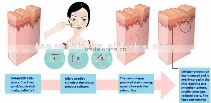 NL-540G BEST! micro dermaroller needles medical grade derma roller (CE)