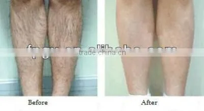 Professional Skin Rejuvenation and Hair Removal IPL Beauty Equiment