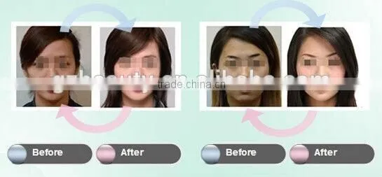 WF-28 RF Face (Eyes) Lifting Machine