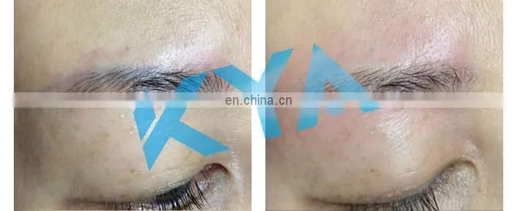 Non Invasive Q Switch ND Yag Laser Machine Tattoo Removal Laser Machine Eyebrow Pigment Scars Freckle Removal Beauty Instrument