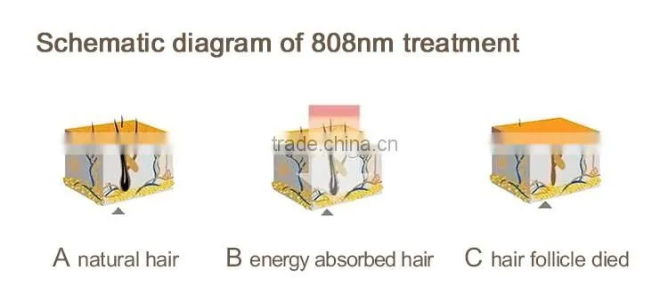 professional painless 808nm diode laser in hair removal