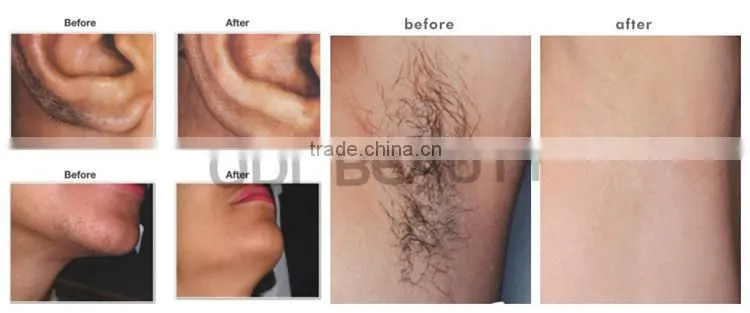 Wholsale 808nm Diode Laser hair removal machines OD-LS808
