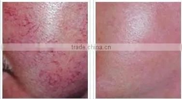 Vascular Removal machine