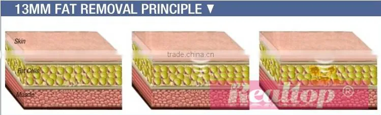 Most professional factory direct price distributor wanted ultralift hifu shaped facial skin firming ultrasonic knife machines