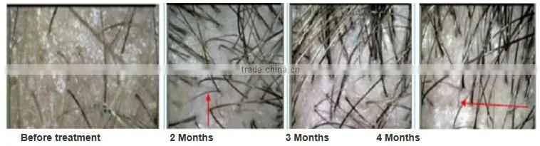 Hair Loss Therapy Device / Inferred Hair Growth Machine With Factory Price