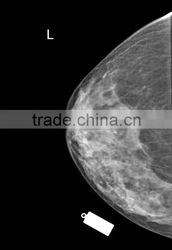 Digital Mammography System
