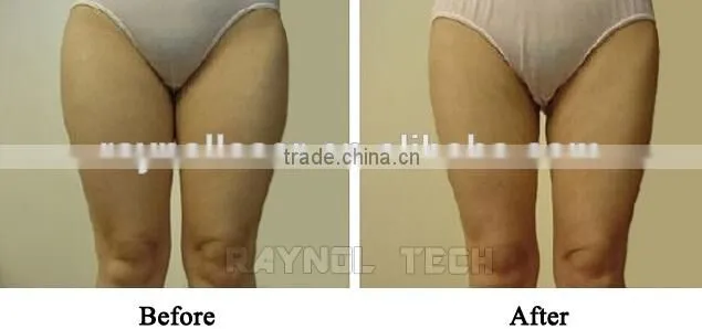 Raynol Laser Multi-Function Liposonix Cavitation Machine
