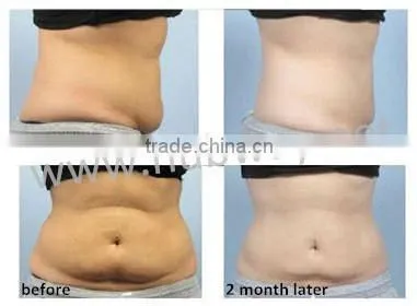 safety fat reduce technology cryolipolysis zelitq equipment