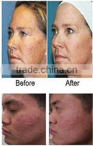 Best Effective !!! Skin rejuvenation and beauty treatment fractional rf microneedle device