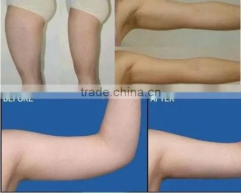 ABS material multi-functional ultrasound liposuction/weight loss machine