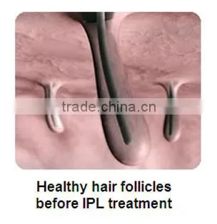 2016 Newest IPL Hair Removal Machine Prices / factory price ipl hand elight