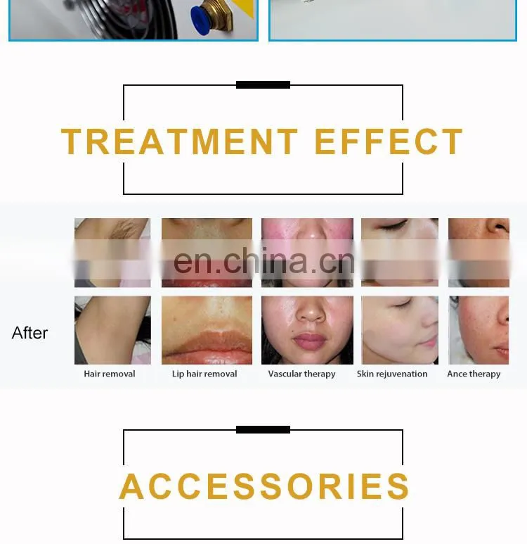 fashion design pink color opt definition depilation hair removal laser machine