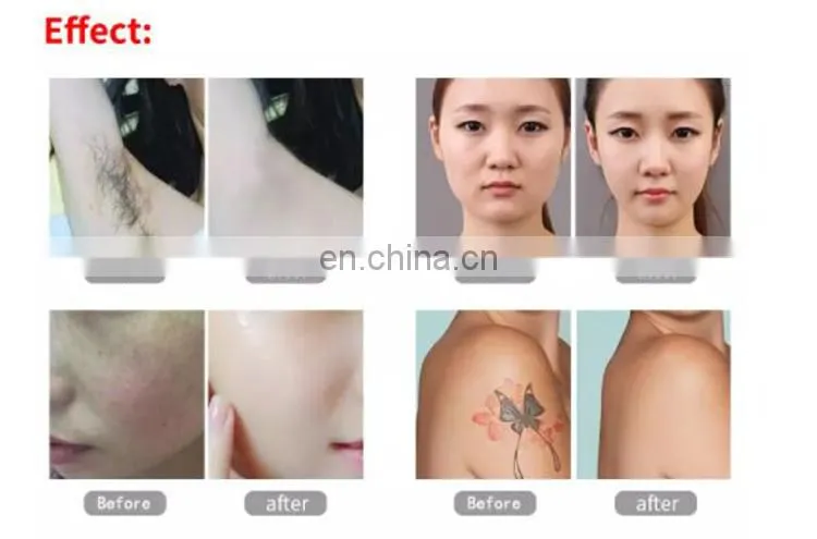 New style 3 in 1 laser hair removal device DPL/OPT laser machine + picosecond laser + RF skin tighten