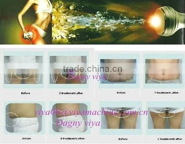 VY-M4 2014 Fat loss RF beauty machine keyword cavitation slimming machine