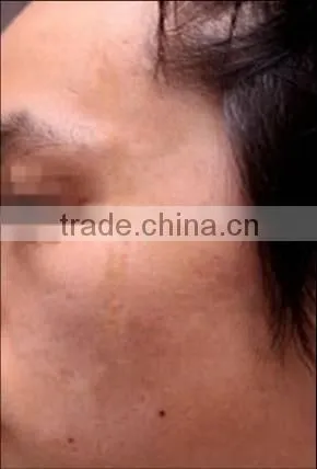 RF tube excited CO2 fractional laser with SFDA and Medical CE