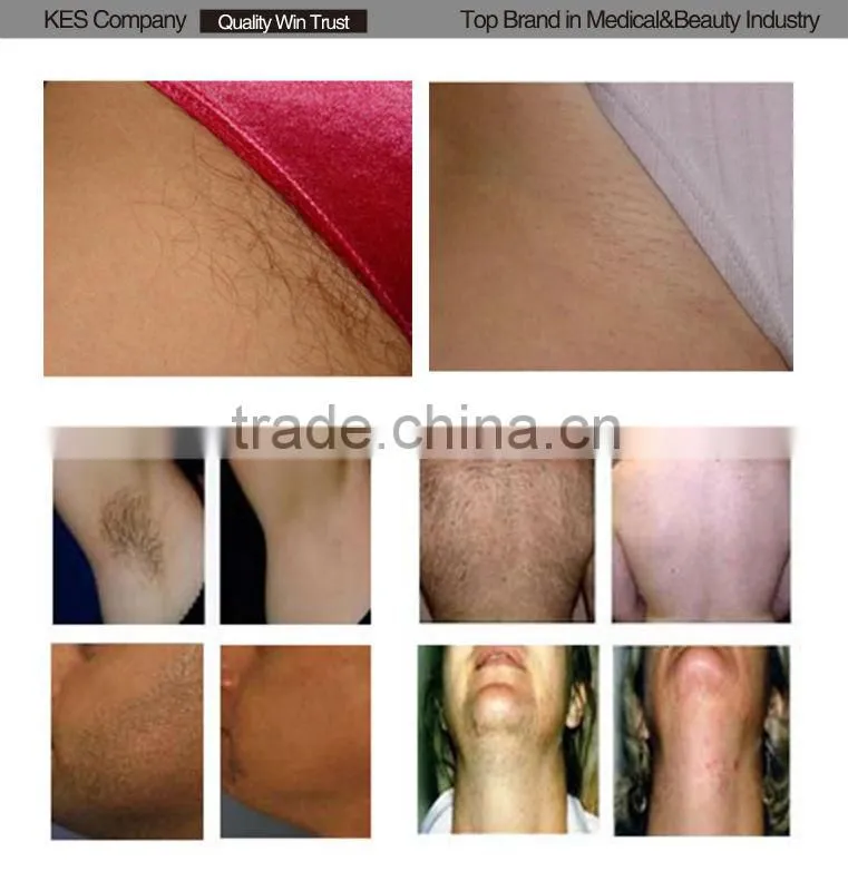 powerful ipl skin care ance removal facial machines skin care