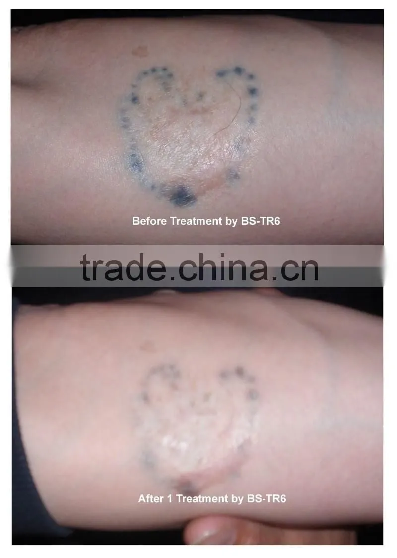 1-6Hz Q switch ND Yag laser tattoo removal spot removal machine